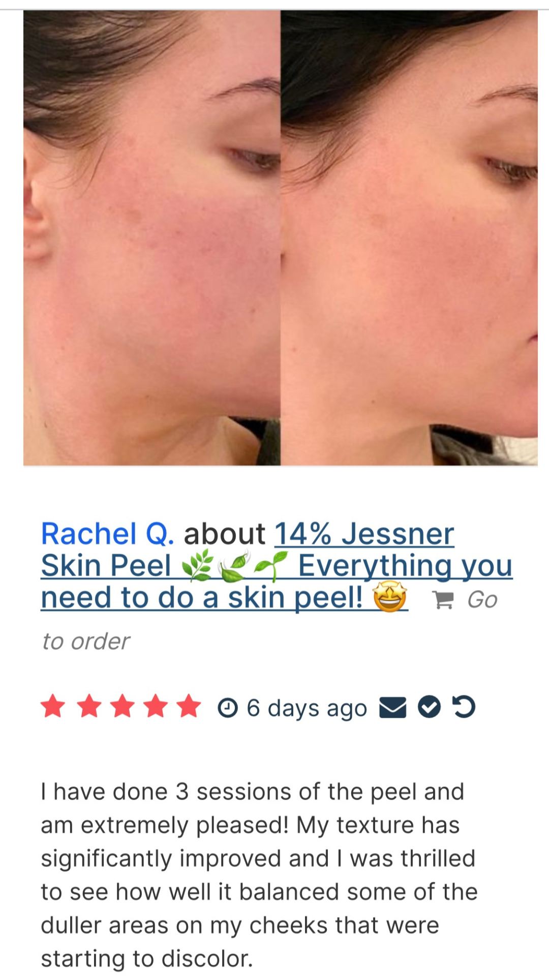 🌿 Jessner Skin Peel Bundle 🌿 Scroll ➡️ to your right to see the "How To Video" 🤩 ➡️
